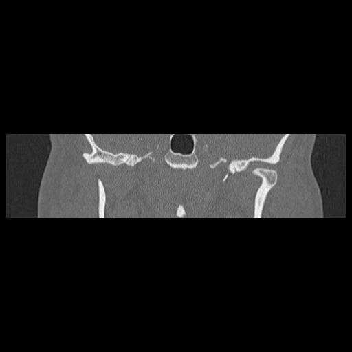 Cholesteatoma (Radiopaedia 84946-100455 Coronal bone window 82).jpg
