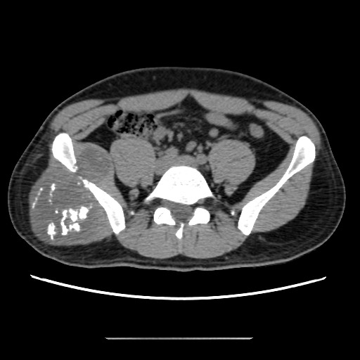 Chondrosarcoma of iliac wing (Radiopaedia 63861-72599 Axial non-contrast 43).jpg