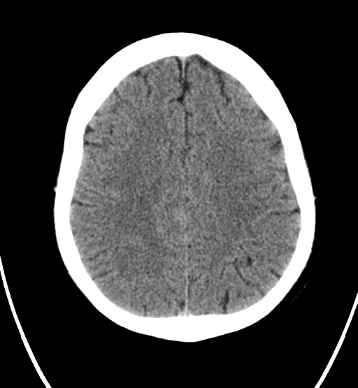 File:Chondrosarcoma of skull base- grade II (Radiopaedia 40948-43653 Axial non-contrast 21).png