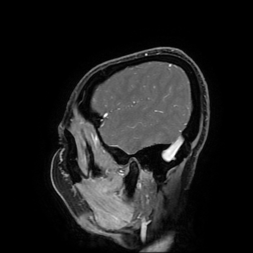 File:Chordoid glioma of third ventricle (Radiopaedia 91612-109340 F 42).jpg