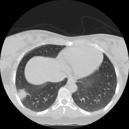 File:Choriocarcinoma of ovary with cerebral and pulmonary metastases (Radiopaedia 25983-26119 Axial lung window 20).jpg