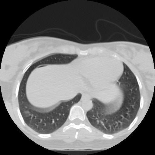 File:Choriocarcinoma of ovary with cerebral and pulmonary metastases (Radiopaedia 25983-26119 Axial lung window 24).jpg