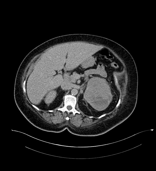 Chromophobe renal cell carcinoma (Radiopaedia 84239-99519 E 63).jpg