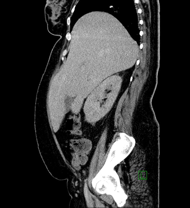 Chromophobe renal cell carcinoma (Radiopaedia 84239-99519 G 85).jpg
