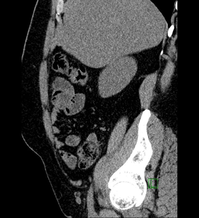 Chromophobe renal cell carcinoma (Radiopaedia 84286-99573 C 140).jpg