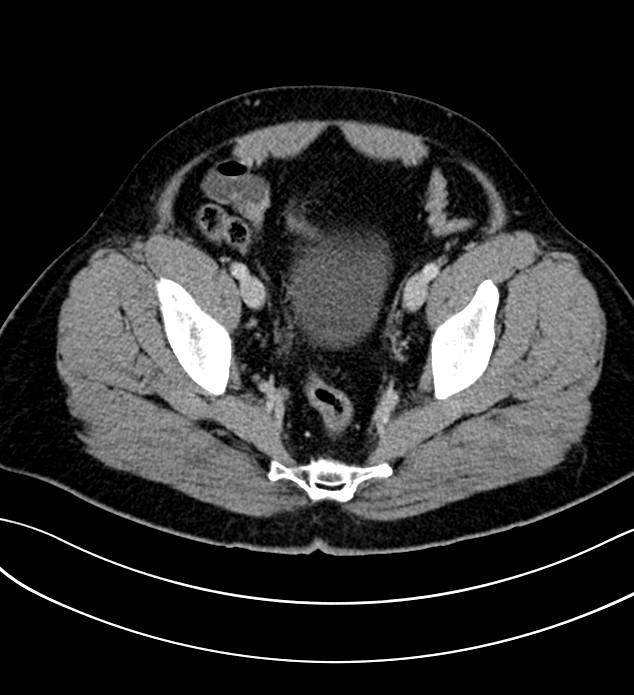 Chromophobe renal cell carcinoma (Radiopaedia 84286-99573 G 63).jpg
