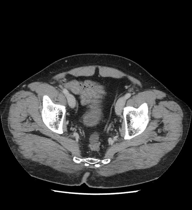 Chromophobe renal cell carcinoma (Radiopaedia 86879-103083 C 136).jpg