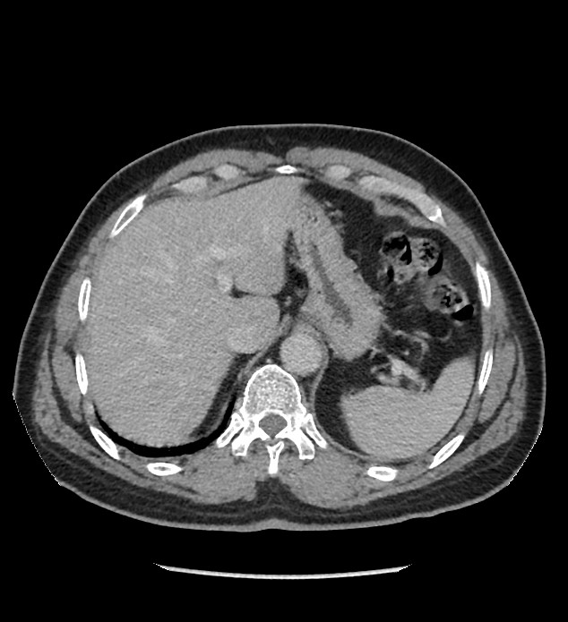 Chromophobe renal cell carcinoma (Radiopaedia 86879-103083 C 26).jpg