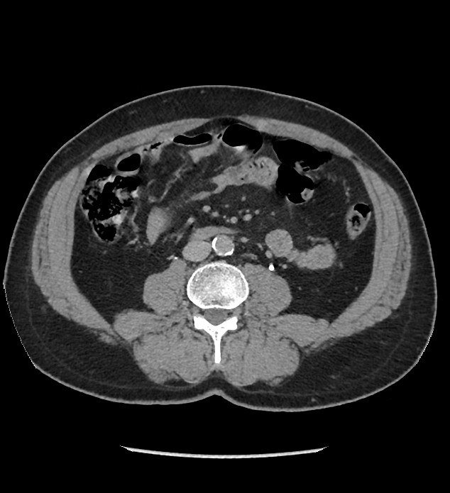 Chromophobe renal cell carcinoma (Radiopaedia 86879-103083 D 81).jpg