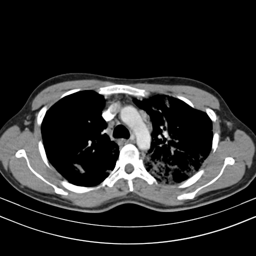 Chronic eosinophilic pneumonia (Radiopaedia 39331-41587 Axial C+ delayed 41).png