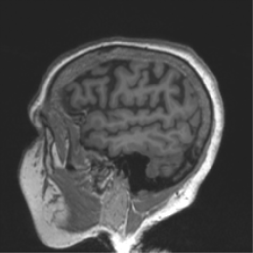 File:Chronic hypertensive encephalopathy (Radiopaedia 39993-42482 Sagittal T1 75).png
