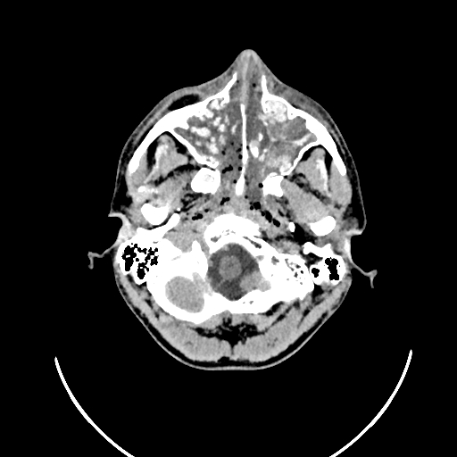 Chronic invasive fungal sinusitis (Radiopaedia 50342-55710 Axial non-contrast 23).jpg