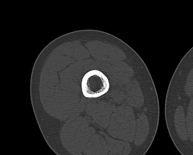 Chronic ostemyelitis of the femur with long sinus tract (Radiopaedia 74947-85982 Axial bone window 100).jpg