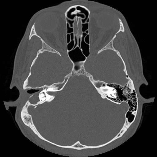 File:Chronic otomastoiditis (Radiopaedia 27138-27309 Axial bone window 39).jpg