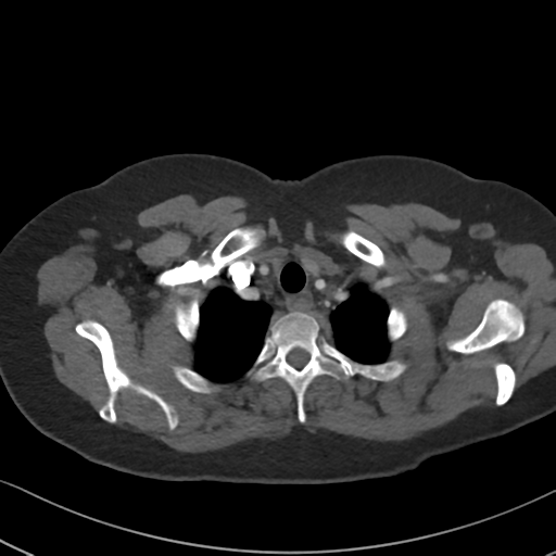 Chronic pulmonary embolus (Radiopaedia 39129-41341 Axial C+ CTPA 14).png