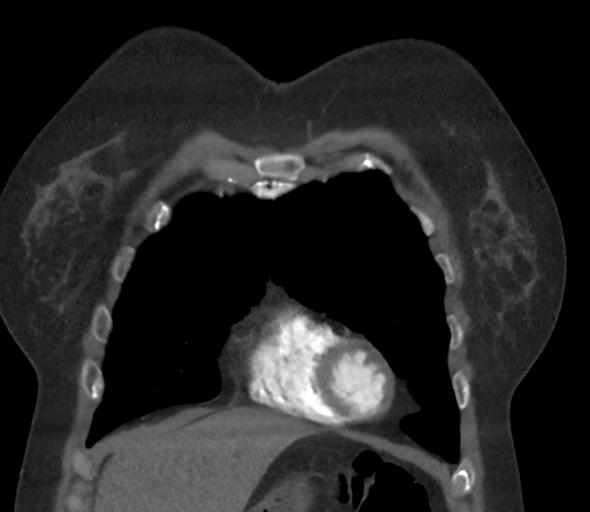 File:Chronic pulmonary embolus (Radiopaedia 39129-41341 Coronal C+ CTPA 20).png