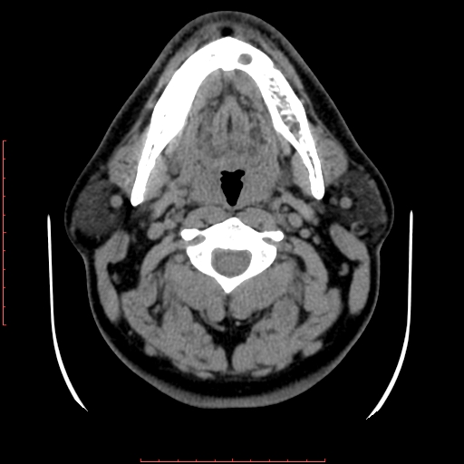Chronic submandibular sialolithiasis (Radiopaedia 69817-79814 Axial non-contrast 93).jpg