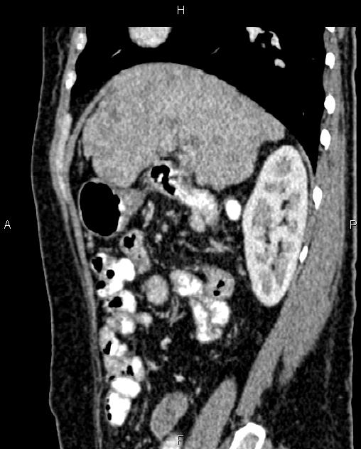 Cirrhosis and hepatocellular carcinoma in the setting of hemochromatosis (Radiopaedia 75394-86594 Axial T1 C+ fat sat 259).jpg