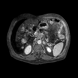 Cirrhosis and hepatocellular carcinoma in the setting of hemochromatosis (Radiopaedia 75394-86594 Axial T1 C+ fat sat 298).jpg