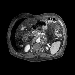 File:Cirrhosis and hepatocellular carcinoma in the setting of hemochromatosis (Radiopaedia 75394-86594 Axial T1 C+ fat sat 300).jpg