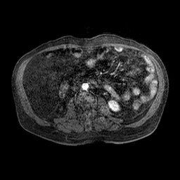 Cirrhosis and hepatocellular carcinoma in the setting of hemochromatosis (Radiopaedia 75394-86594 Axial T1 C+ fat sat 90).jpg