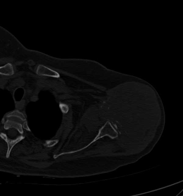 Clear cell chondrosarcoma - humerus (Radiopaedia 63104-71612 Axial bone window 34).jpg