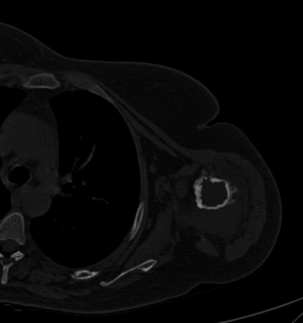 Clear cell chondrosarcoma - humerus (Radiopaedia 63104-71612 Axial bone window 63).jpg