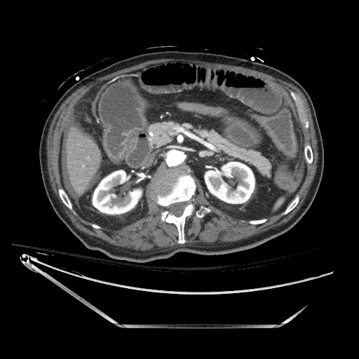 Closed loop obstruction due to adhesive band, resulting in small bowel ischemia and resection (Radiopaedia 83835-99023 B 57).jpg