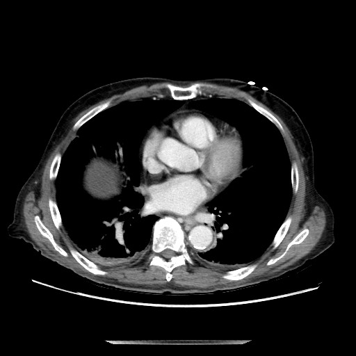 File:Closed loop small bowel obstruction - adhesive disease and hemorrhagic ischemia (Radiopaedia 86831-102990 A 13).jpg