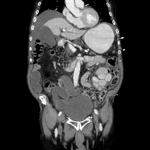 Closed loop small bowel obstruction - adhesive disease and hemorrhagic ischemia (Radiopaedia 86831-102990 B 55).jpg