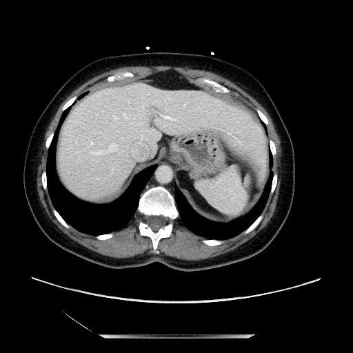 Closed loop small bowel obstruction due to adhesive bands - early and late images (Radiopaedia 83830-99014 A 22).jpg