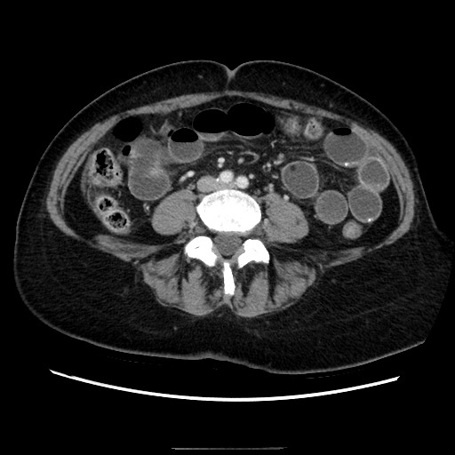 Closed loop small bowel obstruction due to adhesive bands - early and late images (Radiopaedia 83830-99015 A 100).jpg