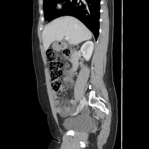 File:Closed loop small bowel obstruction due to trans-omental herniation (Radiopaedia 35593-37109 C 25).jpg