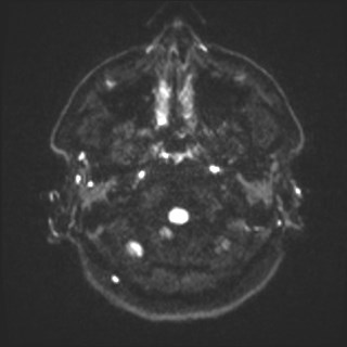 File:Cochlear incomplete partition type III associated with hypothalamic hamartoma (Radiopaedia 88756-105498 Axial DWI 42).jpg