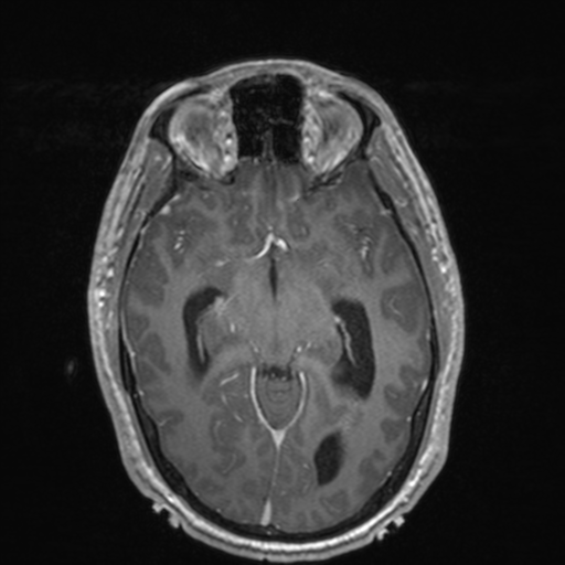File:Colloid cyst (Radiopaedia 44510-48181 Axial T1 C+ 80).png