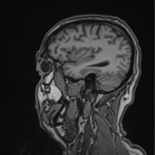 File:Colloid cyst of the third ventricle (Radiopaedia 86571-102662 Sagittal T1 59).png