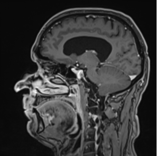 File:Colloid cyst of the third ventricle (Radiopaedia 86571-102662 Sagittal T1 C+ 45).png