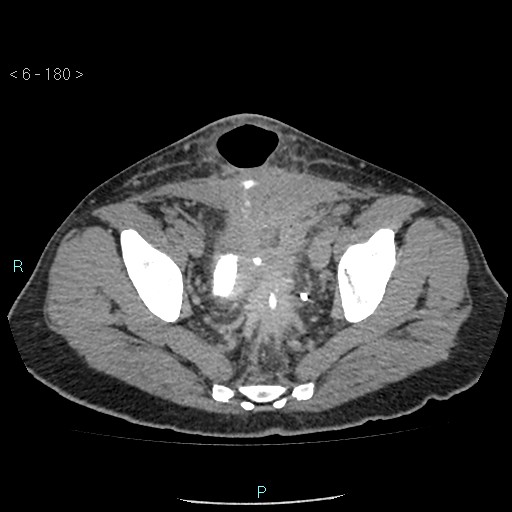 File:Colo-cutaneous fistula (Radiopaedia 40531-43129 A 75).jpg