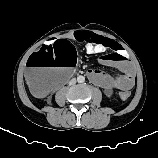 Colocolic intussusception due to large lipoma (Radiopaedia 68773-78482 A 99).jpg