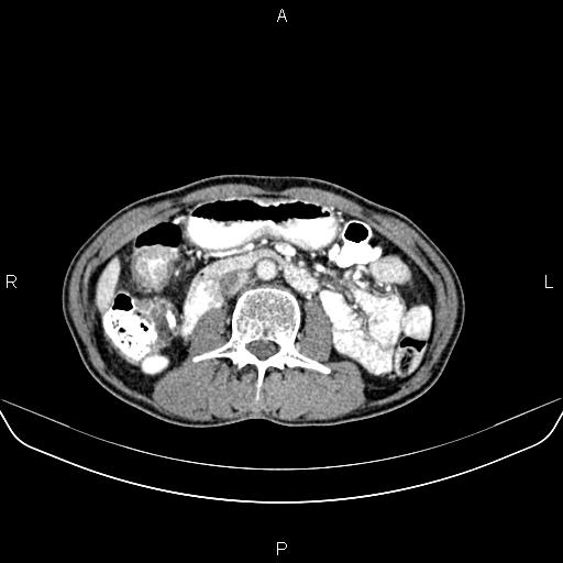 Colon adenocarcinoma - hepatic flexure (Radiopaedia 85635-101395 A 43).jpg