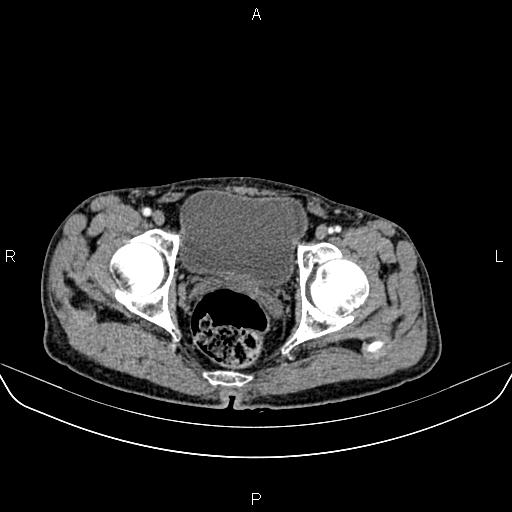 File:Colon adenocarcinoma - hepatic flexure (Radiopaedia 85635-101395 A 91).jpg