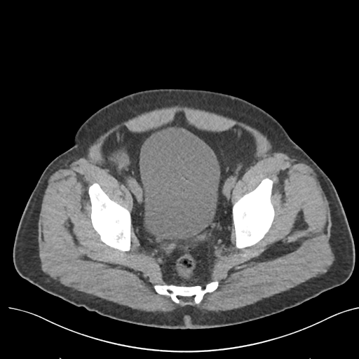 File:Colon adenocarcinoma - splenic flexure (Radiopaedia 34143-35406 Axial Oral contrast 78).png