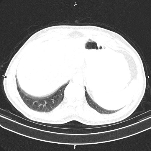 File:Colon cancer (Radiopaedia 85663-101443 Axial lung window 58).jpg