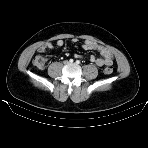Colonic lipoma with colo-colic intussusception (Radiopaedia 58944-66200 A 42).jpg