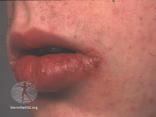File:Granulomatous cheilitis due to Crohn disease (DermNet NZ systemic-gran-cheil2).jpg