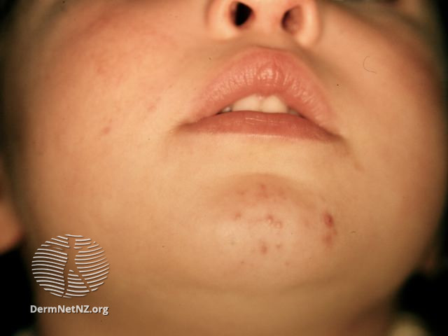 File:Infantile acne (DermNet NZ acne-infantile-acne3).jpg