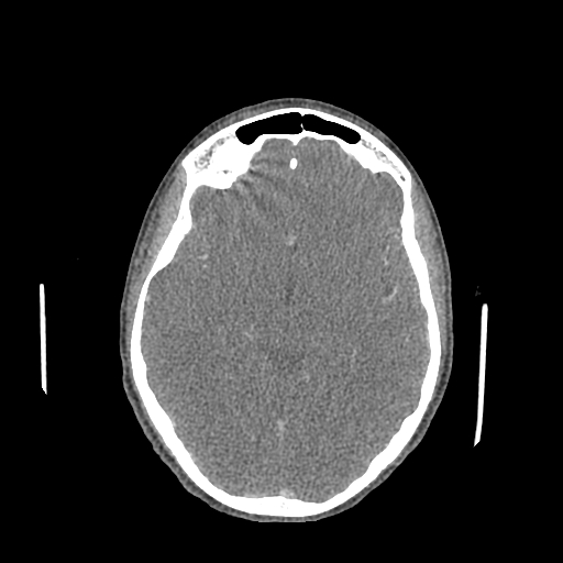 Nasal pyogenic granuloma (lobular capillary hemangioma) (Radiopaedia 85536-101244 C 107).jpg