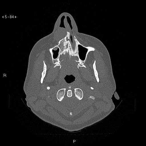 Nasolabial cyst (Radiopaedia 75125-86194 Axial bone window 45).jpg