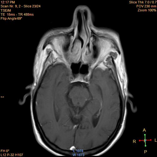File:Nasopharyngeal carcinoma (Radiopaedia 22375-22403 Axial T1 C+ 2).jpg