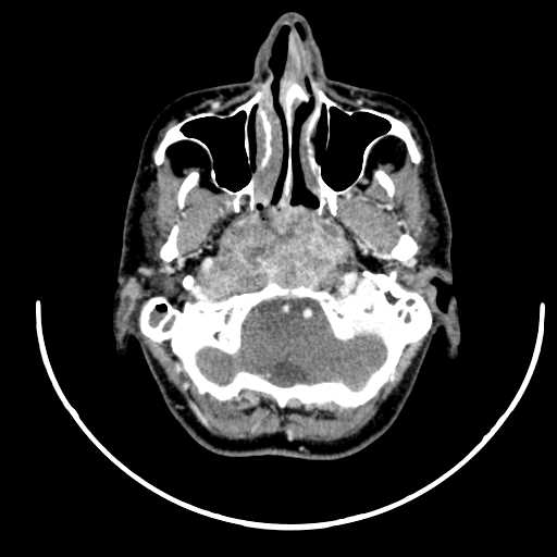 Nasopharyngeal carcinoma - infiltrating the clivus (Radiopaedia 62583-70875 Axial Post contrast 16).jpg